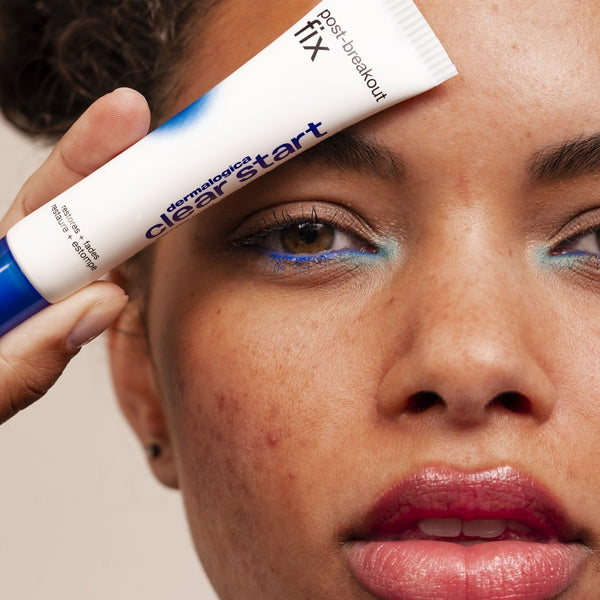 Acne Begone! We Got The Latest Info on How To Get Rid of Your Breakouts